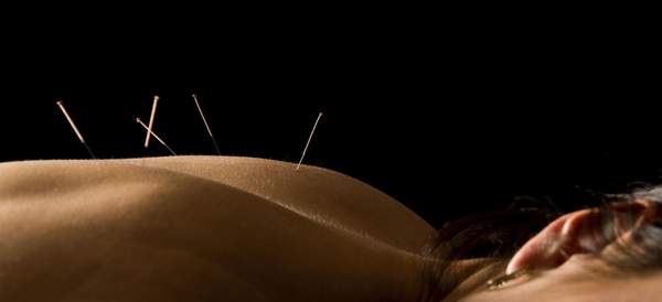 The Benefits of Acupuncture