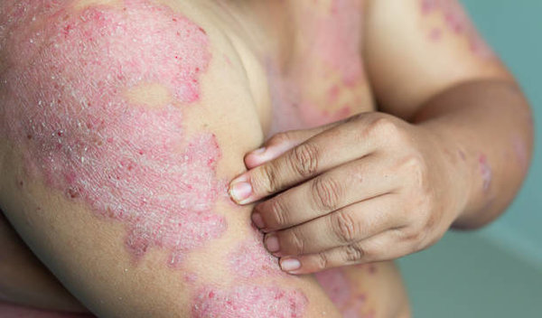 Tips For Managing Psoriasis